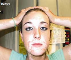 White Spots Vitiligo Patient 2 Patient1 Set1 Before