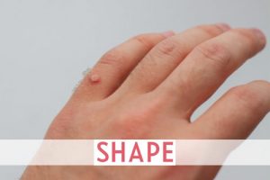 Exactly How to Get Rid of Warts On Your Fingers, Hands, and Feet
