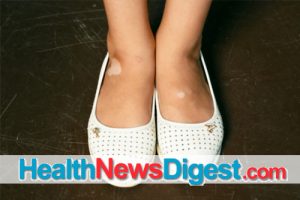 Toning In with Vitiligo: Addressing the Physical and Emotional Tolls of the Pigment-Loss Condition