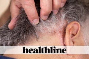 Psoriasis Treatment Dilemma: Biologic Drugs Are Effective but Expensive
