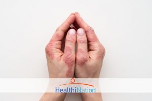 Treating Mild, Moderate and Severe Psoriasis: Options You Should Know