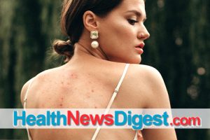 Bye, Bye ‘Bacne’: Breaking Up with Back Acne Breakouts