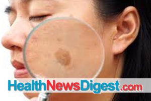 Patch Work: How to Treat Skin Discolored by Melasma