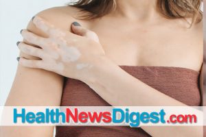 Balancing Act: Managing the Pigment-Loss Condition Vitiligo
