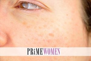 How to Finally Minimize the Appearance of Pesky Age Spots