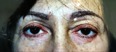 Lower Eyelid Surgery P2 Patient1 Set1 After