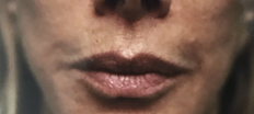 Upper Lip Lift P3 Patient1 Set1 After