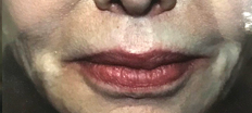 Upper Lip Lift P4 Patient1 Set1 After