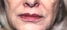 Upper Lip Lift P5 Patient1 Set1 After