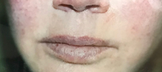 Upper Lip Lift P1 Patient1 Set1 Before Page