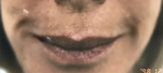 Upper Lip Lift P3 Patient1 Set1 Before Page