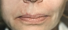 Upper Lip Lift P4 Patient1 Set1 Before