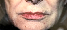 Upper Lip Lift P5 Patient1 Set1 Before