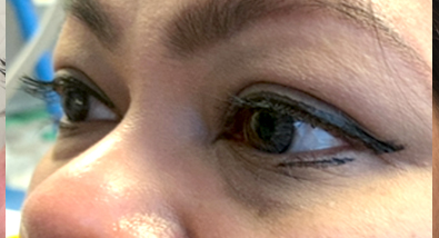 Restylane lower eyelid filler Patient1 Set1 After
