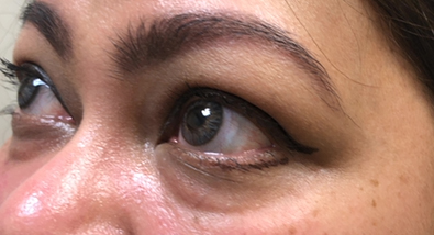 Restylane lower eyelid filler Patient1 Set1 Before