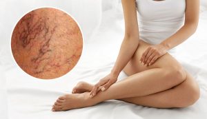 5 Things You Can Do To Prevent Spider Veins
