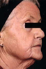 Fraxel patient after photo