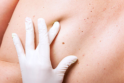 Skin Cancer, Westchester Service Photo3