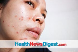 For Adults with Acne: Clear-Skin Options Can Be Antibiotic-Free