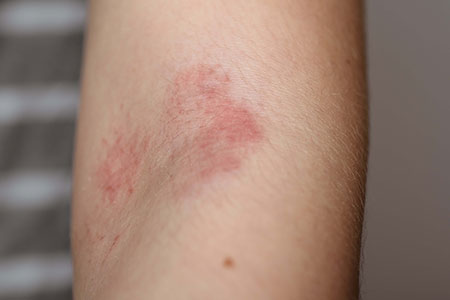 Eczema, Westchester Service Photo1