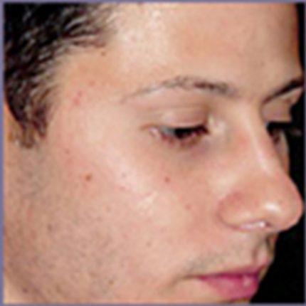 Acne Treatment 6 with Acleara Laser Patient1 Set1 After Page