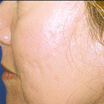 Acne Scars 5 Patient1 Set1 After