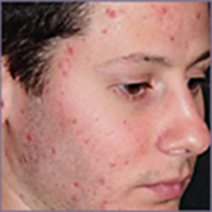 Acne Treatment 6 with Acleara Laser Patient1 Set1 Before