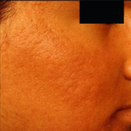 Acne Scars 4 Patient1 Set1 After