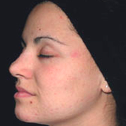 Acne Treatment 5 with Acleara Laser Patient1 Set1 After