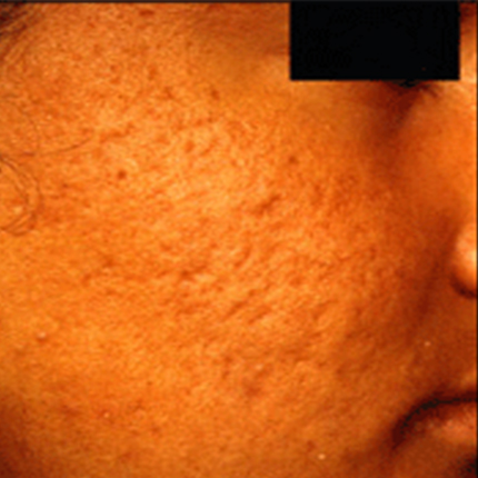 Acne Scars 4 Patient1 Set1 Before