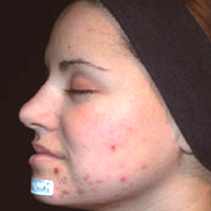 Acne Treatment 5 with Acleara Laser Patient1 Set1 Before