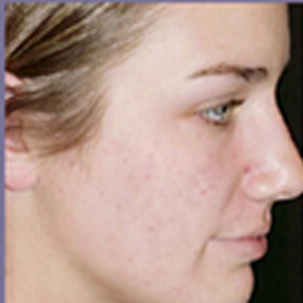 Acne Treatment 4 with Acleara Laser Patient1 Set1 After Page