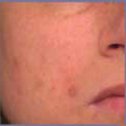 Acne Scars 3 Patient1 Set1 After