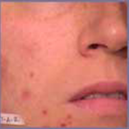 Acne Scars 3 Patient1 Set1 Before