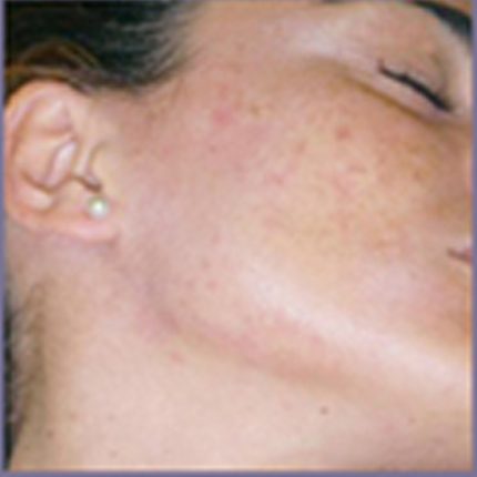 Acne Treatment 3 – with Acleara Laser Patient1 Set1 After