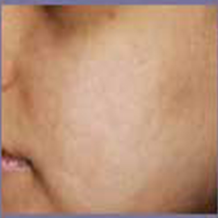 Acne Scars 2 Patient1 Set1 After