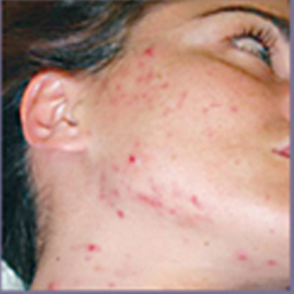 Acne Treatment 3 – with Acleara Laser Patient1 Set1 Before Page