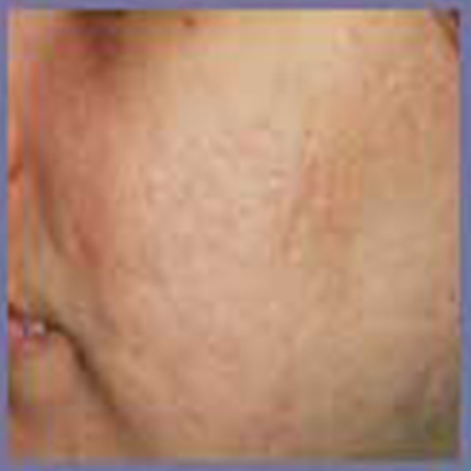 Acne Scars 2 Patient1 Set1 Before