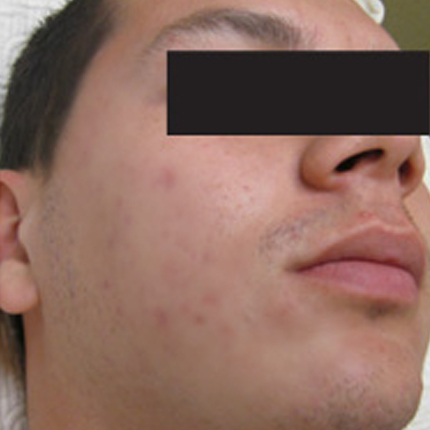 Acne Treatment 2 – with Acleara Laser Patient1 Set1 After