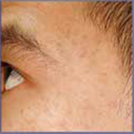 Acne Scars 1 Patient1 Set1 After