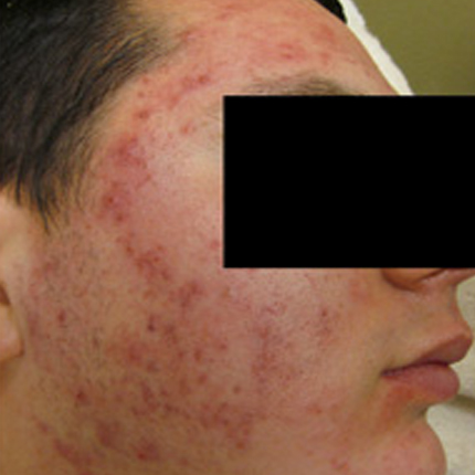 Acne Treatment 2 – with Acleara Laser Patient1 Set1 Before