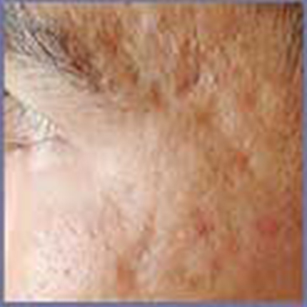 Acne Scars 1 Patient1 Set1 Before