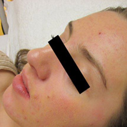 Acne Treatment 1 – with Acleara Laser Patient1 Set1 After