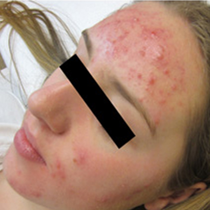 Acne Treatment 1 – with Acleara Laser Patient1 Set1 Before