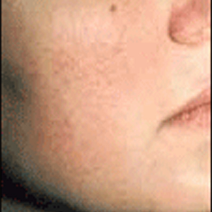 Rosacea – Facial Telangiectasia 2 Patient1 Set1 After