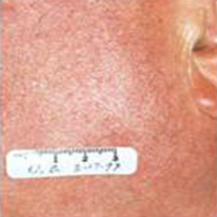 Rosacea – Facial Telangiectasia 4 Patient1 Set1 After