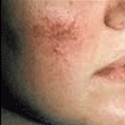 Rosacea – Facial Telangiectasia 2 Patient1 Set1 Before Page
