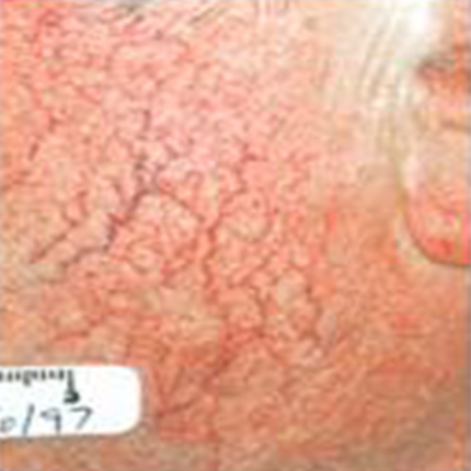 Rosacea – Facial Telangiectasia 4 Patient1 Set1 Before Page