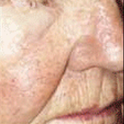 Rosacea – Facial Telangiectasia 1 Patient1 Set1 After