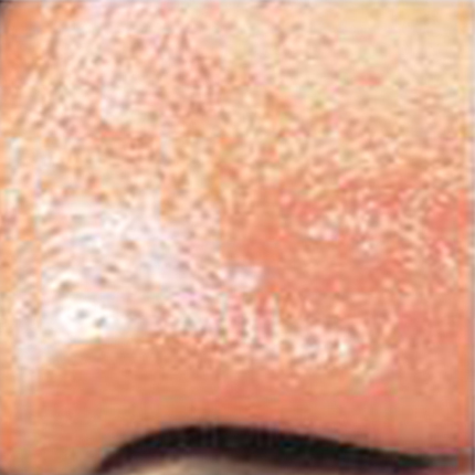 Rosacea – Facial Telangiectasia 3 Patient1 Set1 After